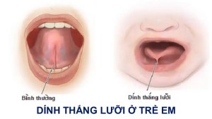 dinh-thang-luoi-o-tre-em